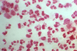 Gram stain of intracellular Gram-negative N. gonorrhoeae diplococci