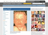 Immunization Action Coalition - Measles Clinical Images